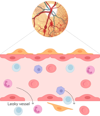 Leaky, inflamed, & angiogenic vessel (Disease)